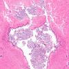 7B3 Bacterial Meningitis (Case 6) N6 cerebral aqueduct H&E