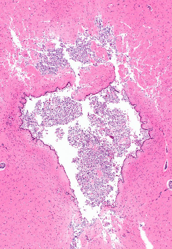 7B3 Bacterial Meningitis (Case 6) N6 cerebral aqueduct H&E