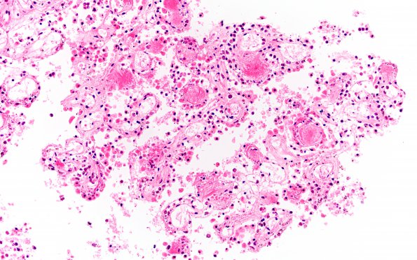 7B4 Meningitis, bacterial (Case 6) Choroid plexus H&E 2