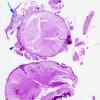 7D1 Bacterial Meningitis (Case 6) N10 H&E copy