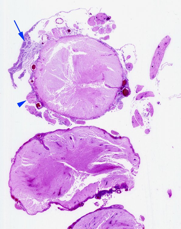 7D1 Bacterial Meningitis (Case 6) N10 H&E copy