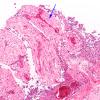 7D2 Meningitis, bacterial (Case 6) N10 H&E 1 copy