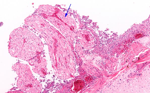 7D2 Meningitis, bacterial (Case 6) N10 H&E 1 copy