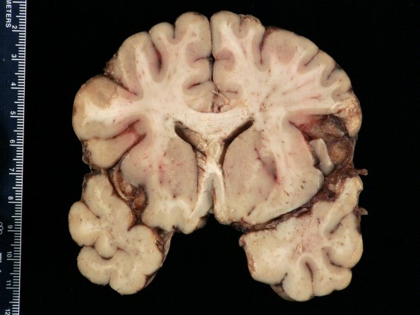 8A3 Meningitis, Klebsiella (Case 8) Gross_13