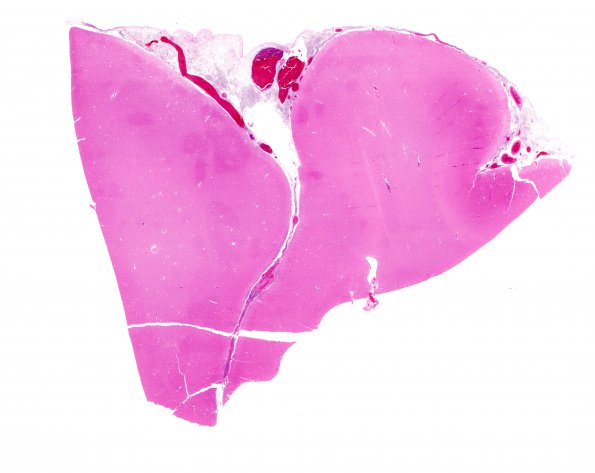 8B Meningitis, Klebsiella (Case 8) H&E whole mount 1