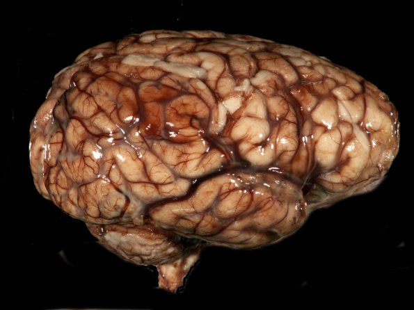 9A1 Meningitis, GBStrep (Case 7) Gross_7