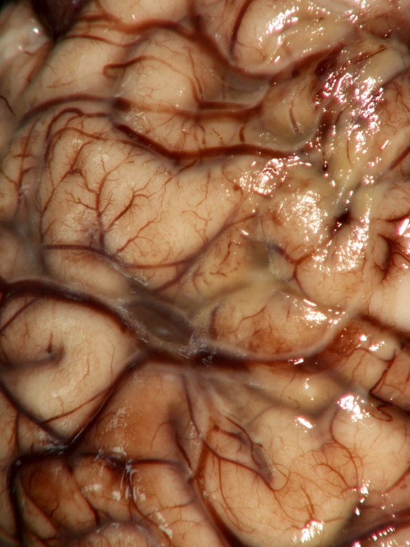 9A2 Meningitis, GBStrep (Case 7) Gross_5