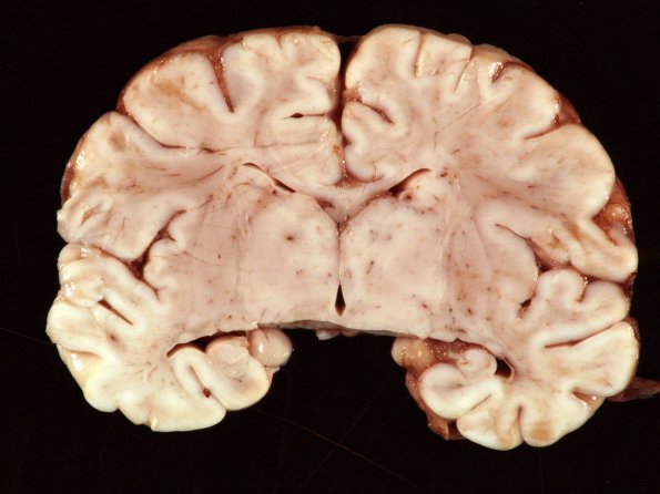 9A3 Meningitis, GBStrep (Case 7) Gross_9