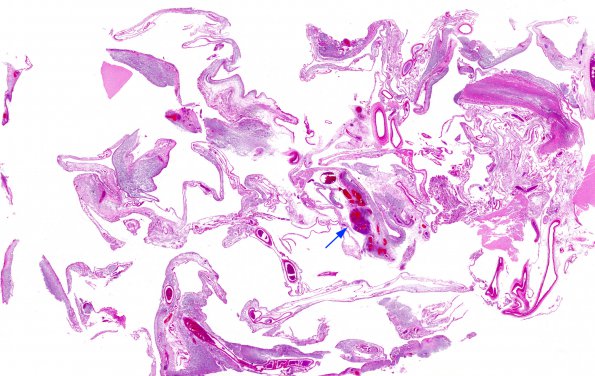 9B1 Meningitis, GBStrep (Case 7) H&E whole mount 1 copy