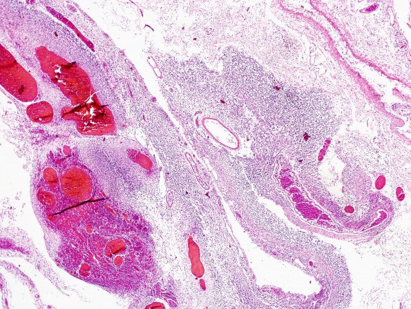 9B2 Meningitis, GBStrep (Case 7) H&E 11