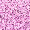 9B3 Meningitis, GBStrep (Case 7) H&E 1