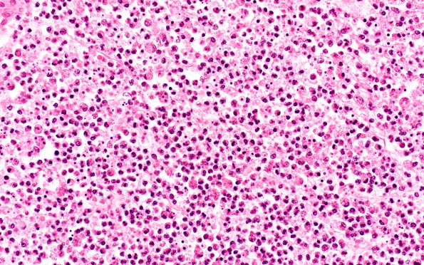 9B3 Meningitis, GBStrep (Case 7) H&E 1