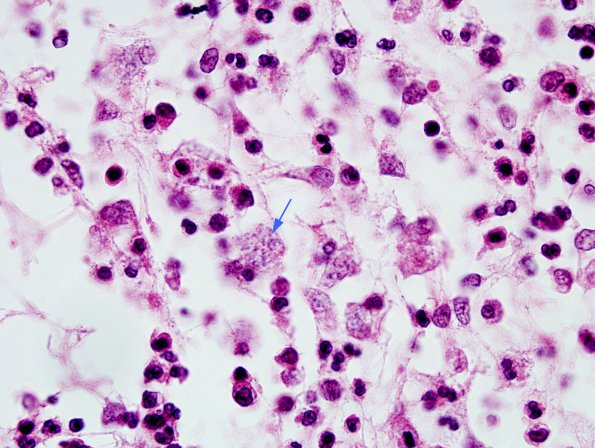 9B4 Meningitis, GBStrep (Case 7) H&E 5 copy