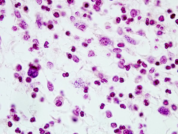 9C Meningitis, GBStrep (Case 7) Gram 8