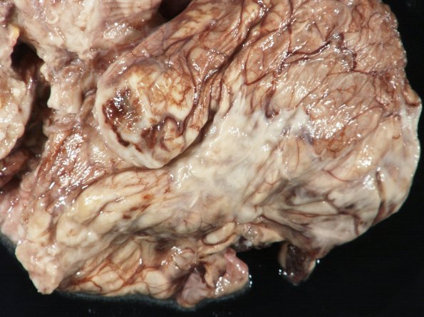 10A1 Meningitis & SSS Thrombosis (Case 10) gross 2_1