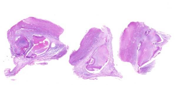 10B1 Meningitis & SSS Thrombosis (Case 10) H&E whole mount 3