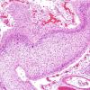 10B10 Meningitis & SSS Thrombosis (Case 10) H&E 9