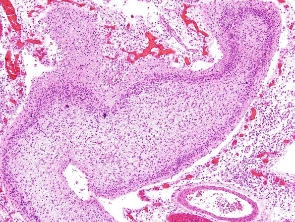 10B10 Meningitis & SSS Thrombosis (Case 10) H&E 9