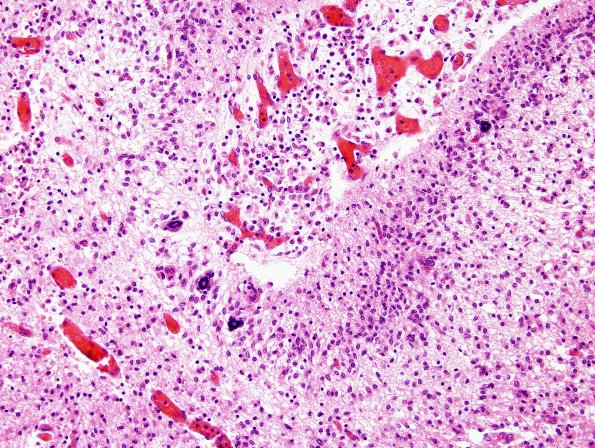 10B11 Meningitis & SSS Thrombosis (Case 10) H&E 8