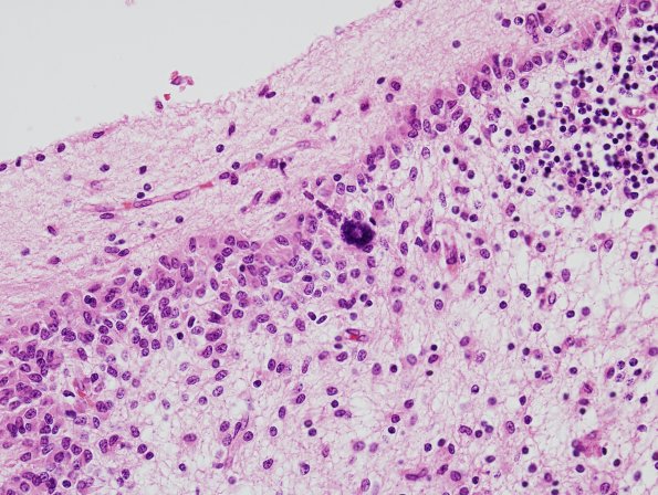 10B12 Meningitis & SSS Thrombosis (Case 10) H&E 7