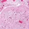 10B13 Meningitis & SSS Thrombosis (Case 10) N2 H&E 5A