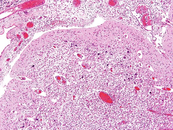 10B13 Meningitis & SSS Thrombosis (Case 10) N2 H&E 5A