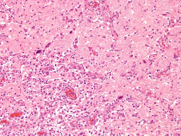 10B14 Meningitis & SSS Thrombosis (Case 10) N2 H&E 3