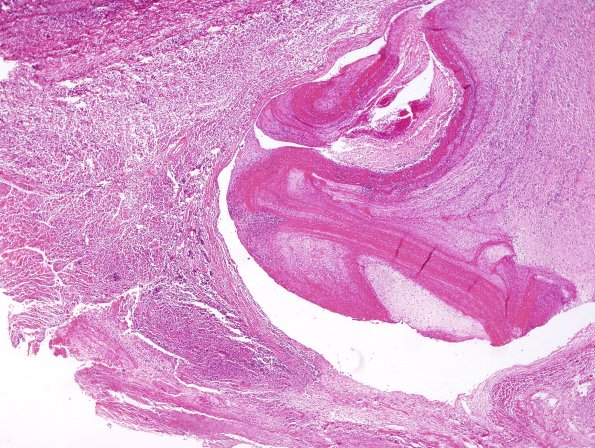 10B2 Meningitis & SSS Thrombosis (Case 10) H&E 5