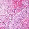 10B3 Meningitis & SSS Thrombosis (Case 10) H&E 4