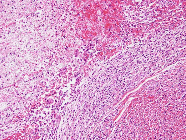 10B3 Meningitis & SSS Thrombosis (Case 10) H&E 4