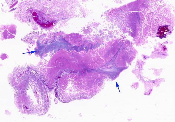 10B4 Meningitis & SSS Thrombosis (Case 10) N5 H&E whole mount 3 copy