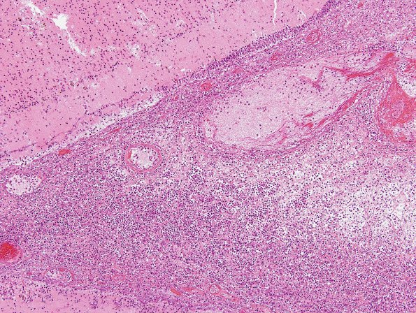 10B5 Meningitis & SSS Thrombosis (Case 10) N5 H&E 6