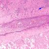 10B6 Meningitis & SSS Thrombosis (Case 10) N5 H&E 3 copy