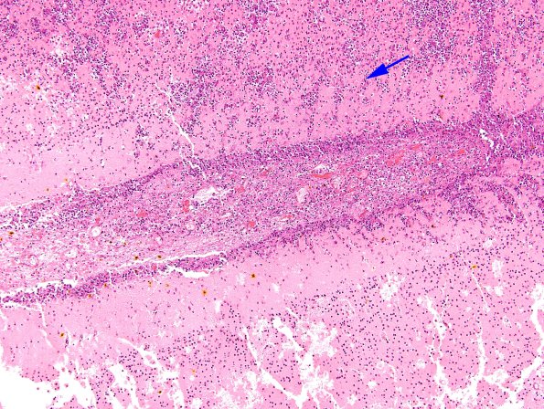 10B6 Meningitis & SSS Thrombosis (Case 10) N5 H&E 3 copy