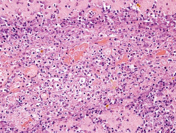 10B7Meningitis & SSS Thrombosis (Case 10) N5 H&E 1