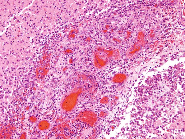 10B8 Meningitis & SSS Thrombosis (Case 10) N5 H&E 8A