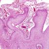 10B9 Meningitis  SSS Thrombosis (Case 10) H&E 10