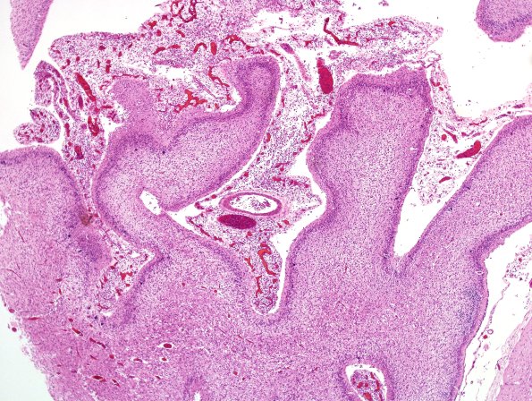 10B9 Meningitis  SSS Thrombosis (Case 10) H&E 10