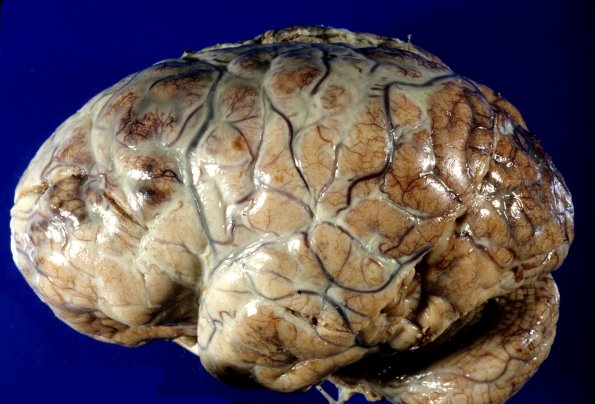 11A1 Meningitis, Superior saggital sinus thrombosis (Case 11)-2