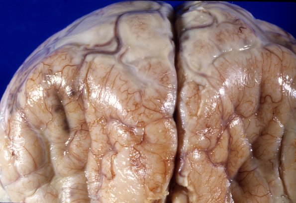 11A2 Meningitis, Acute Bacterial (PC) (Case 11) gross