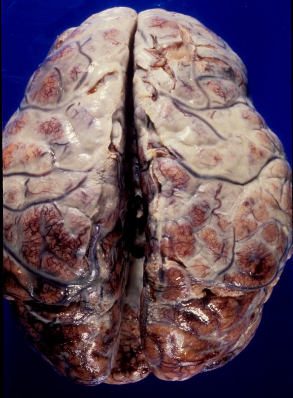 11A3 Meningitis, PC (Case 11) A1