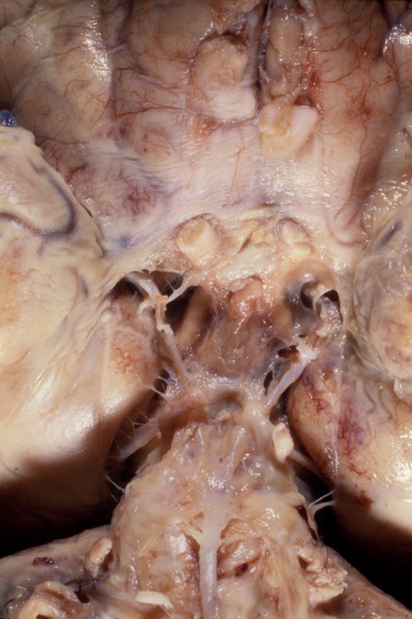 11A4 Meningitis, PC (Case 11) A3