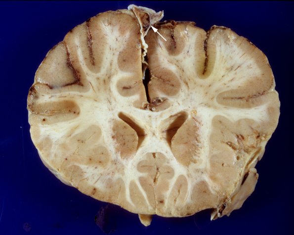 11A5 Meningitis, Superior saggital sinus thrombosis (Case 11)-1 copy