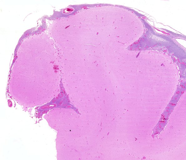 11B1 Meningitis, bacterial (Case 11) PC H&E 1