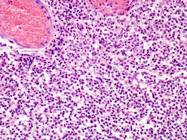 11B2 Bacterial Meningitis (Case 11) H&E 1