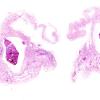 11B3 Meningitis, Acute Bacterial (PC) (Case 11)