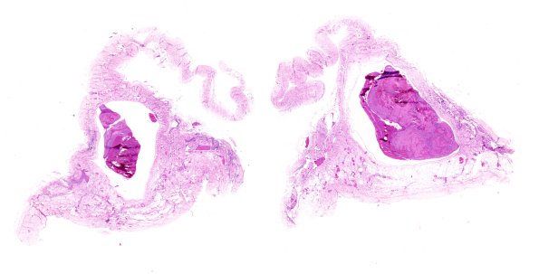 11B3 Meningitis, Acute Bacterial (PC) (Case 11)