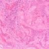 11B4 Meningitis, Acute Bacterial (PC) (Case 11) SSS thrombus