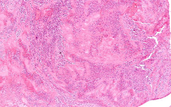 11B4 Meningitis, Acute Bacterial (PC) (Case 11) SSS thrombus