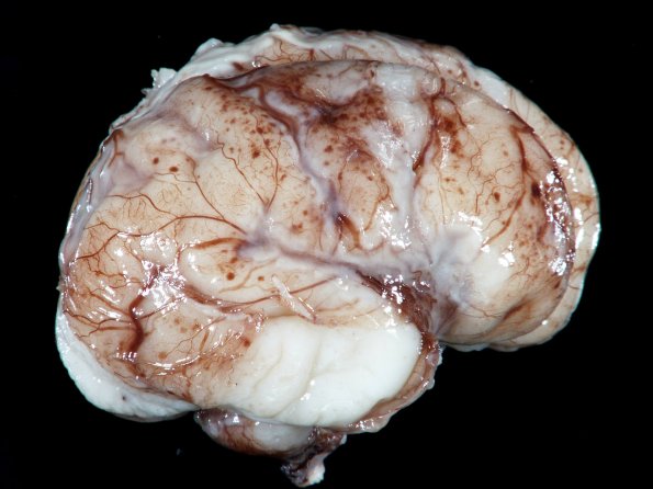 12A1 Meningitis, E Coli (Case 12) 4